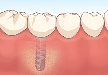 implant 01