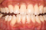 whitening 02