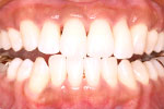 whitening 03