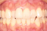 whitening 02