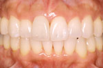 whitening 03