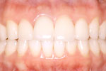 whitening 03