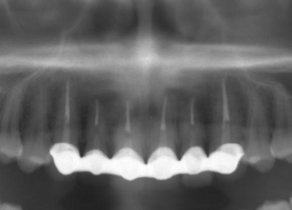 セラミック矯正が気になる方が多いみたいなので